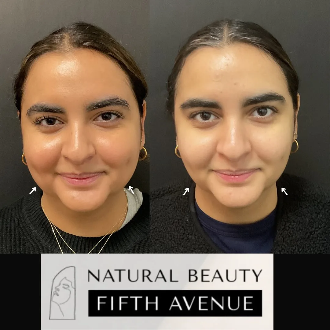 Before and after comparison of a patient's face showing reduced forehead lines following Botox injections at Natural Beauty Fifth Avenue